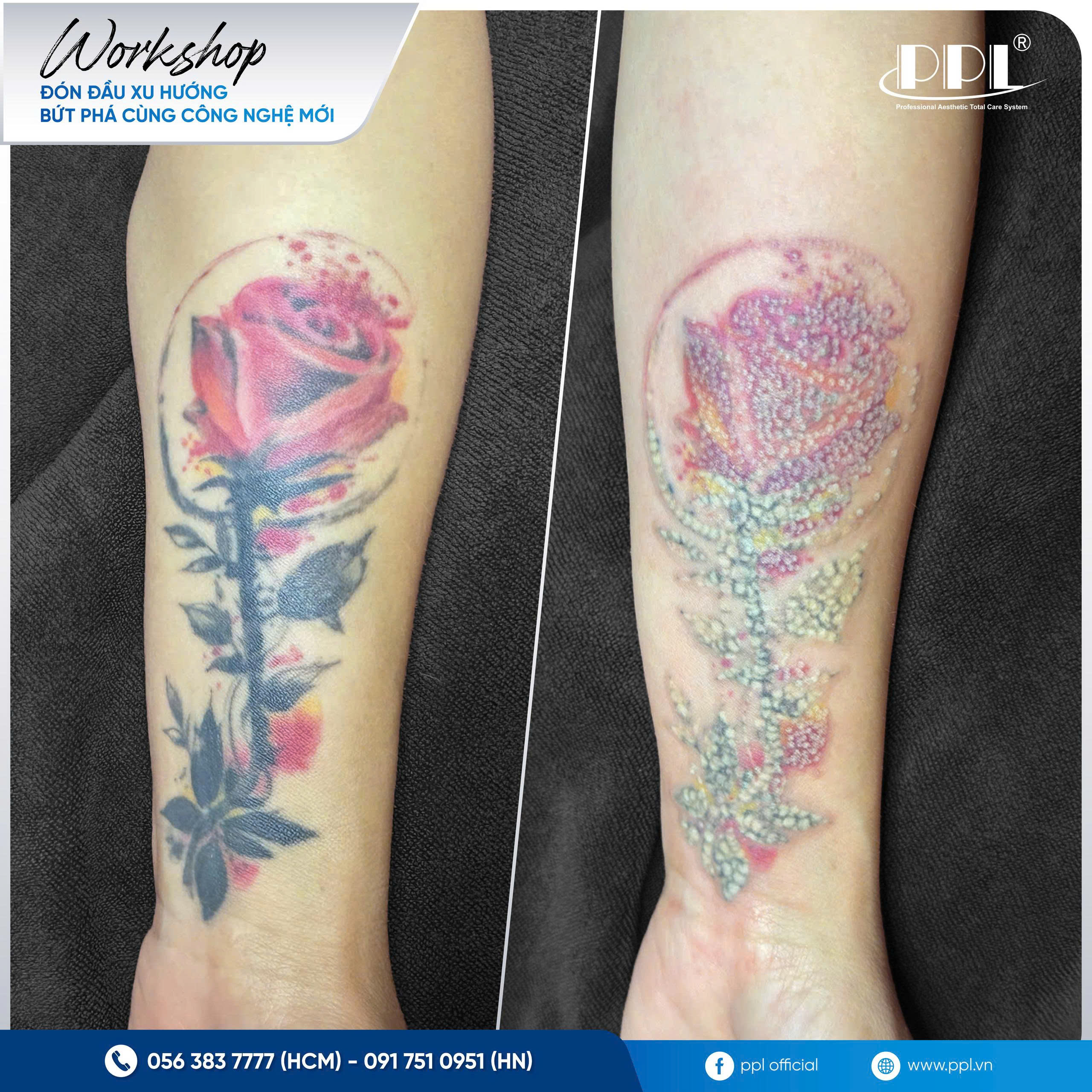 anh truoc va sau khi ban laser xoa